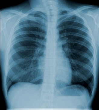 Traitement médical de l'oedème pulmonaire cardiogénique - Réalités ...