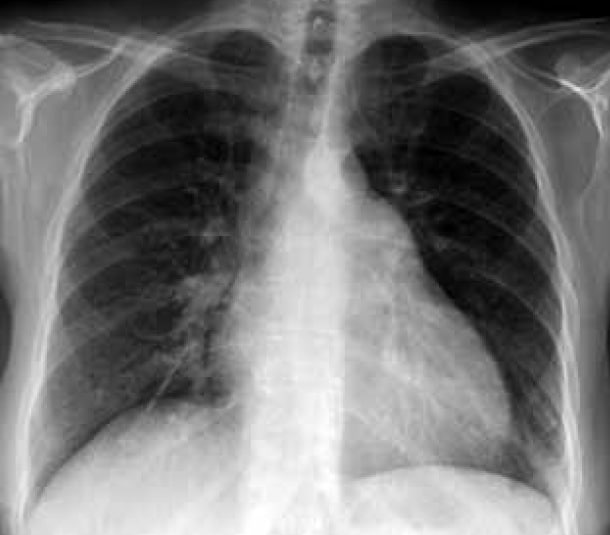 Hypertension pulmonaire : du symptôme au diagnostic - Réalités ...
