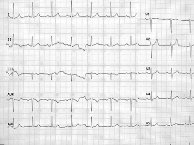 Insuffisance cardiaque et cardiomyopathies : quoi de neuf ...