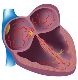 Cardioversion électrique : comment ça se passe ?