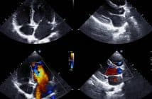 Dysfonction de prothèse valvulaire : quelle imagerie utiliser ?
