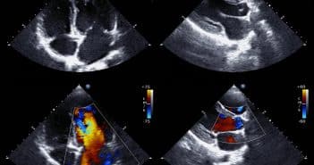 Dysfonction de prothèse valvulaire : quelle imagerie utiliser ?