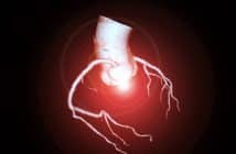Ischémie myocardique