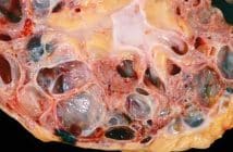 Hypertension artérielle et polykystose rénale autosomique dominante